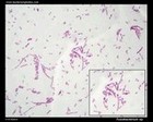 fusobacterium